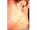 Warts - flat on the cheek and neck