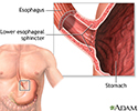Achalasia - series
