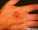 Bowen's disease on the hand