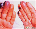 Cryoglobulinemia of the fingers