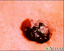 Skin cancer - raised multi-color melanoma