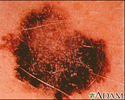 Skin cancer, melanoma - flat, brown lesion