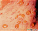 Bullous pemphigoid - close-up of tense blisters