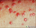 Xanthoma, eruptive - close-up