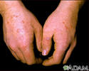 Erythema multiforme on the hands