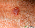 Lichen planus - close-up
