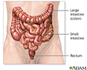 Colon cancer - Series