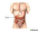 Colon diverticula - series