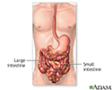 Intestinal obstruction repair - series