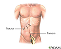 Laparoscopic surgery - series - Incision