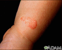 Ringworm - tinea corporis on an infant's leg