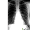 Coccidioidomycosis - chest X-ray
