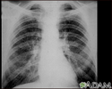 Coal workers pneumoconiosis - stage II