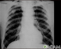 Coal workers pneumoconiosis - stage II