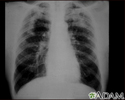 Coal workers pneumoconiosis, complicated