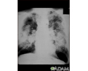 Coal workers pneumoconiosis, complicated