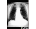 Pulmonary nodule - front view chest x-ray