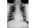 Sarcoid, stage I - chest X-ray