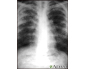 Sarcoid, stage II - chest X-ray