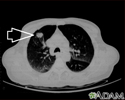 Lung mass, right upper lobe - CT scan