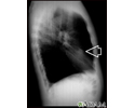 Lung nodule, right middle lobe - chest X-ray