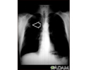 Lung mass, right upper lung - chest X-ray