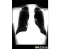 Lung nodule - front view chest X-ray