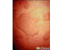 Hives (urticaria) - close-up