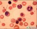 Erythroblastosis fetalis - photomicrograph