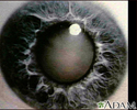 Cataract - close-up of the eye