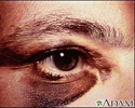 Black eye