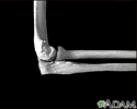 Elbow - side view