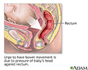 Emergency Childbirth