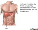 Chronic hepatitis
