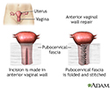 Anterior vaginal wall repair