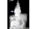 Hiatal hernia - X-ray
