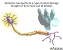 Alcoholic neuropathy