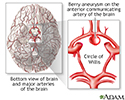 Cerebral aneurysm