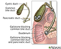 Choledocholithiasis