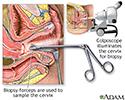 Colposcopy-directed biopsy