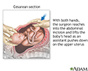 Cesarean section