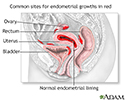 Endometriosis