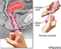 The female condom