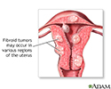 Fibroid tumors