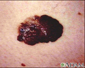 Skin cancer, melanoma - raised, dark lesion