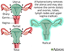 Hysterectomy