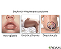 Beckwith-Wiedemann syndrome