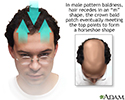 Male pattern baldness