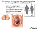 Absence of menstruation (amenorrhea)