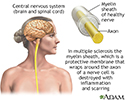 Multiple sclerosis